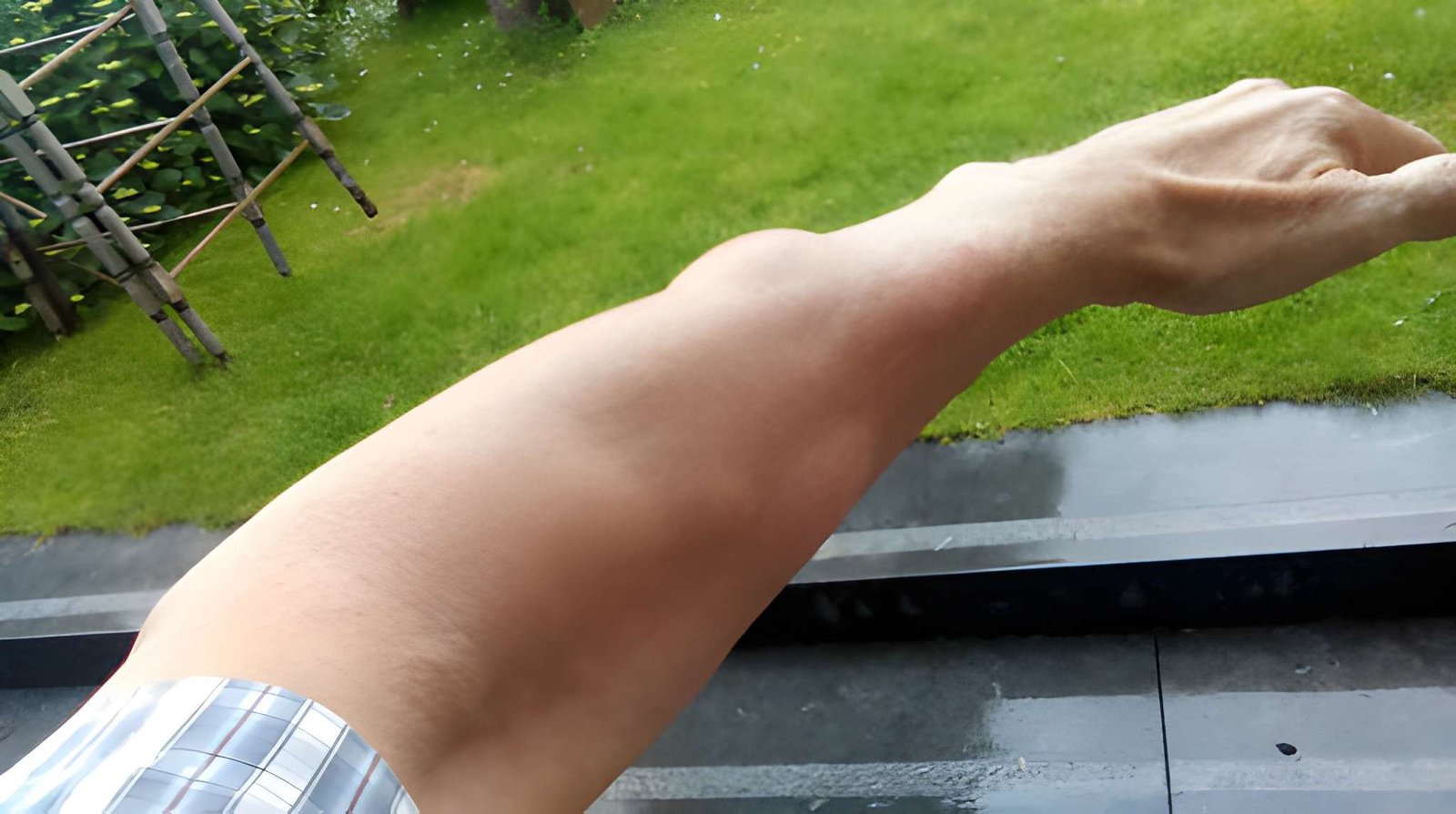 Lipoma Removal